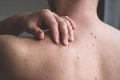 Najlepsze sposoby na łuszczycę - czy maści są skuteczne?